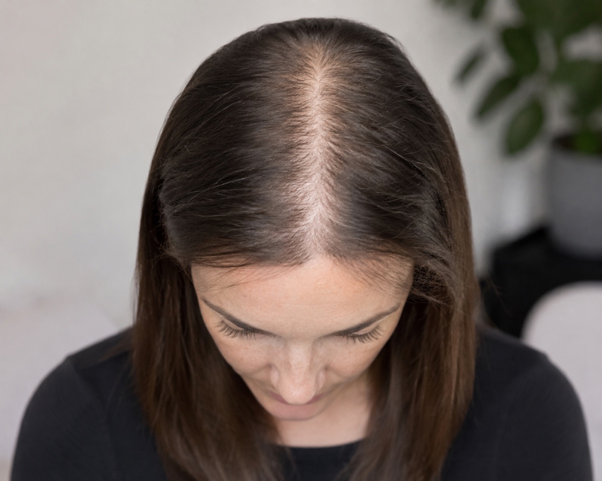 Women's hair loss treated with scalp micropigmentation