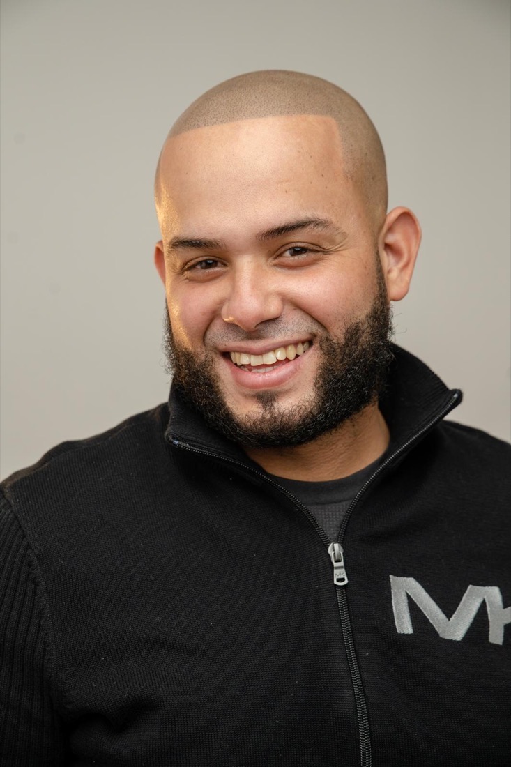 Scalp micropigmentation result at Erik Roberto SMP Studio