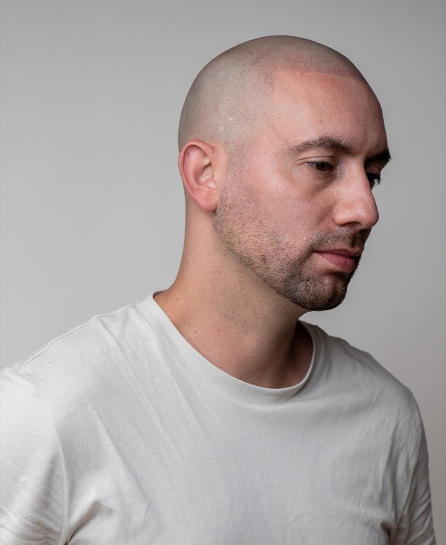 Scalp micropigmentation result at Erik Roberto SMP Studio