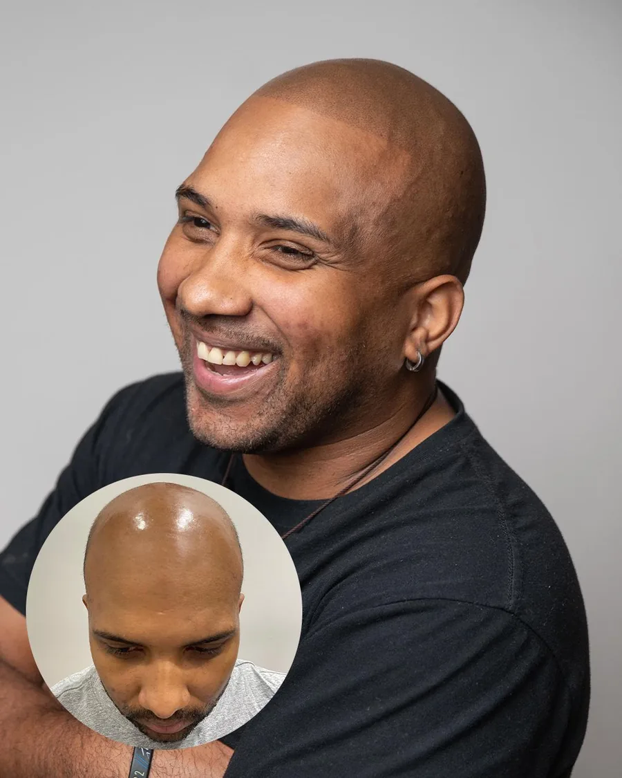 Scalp micropigmentation before and after at Erik Roberto SMP Studio