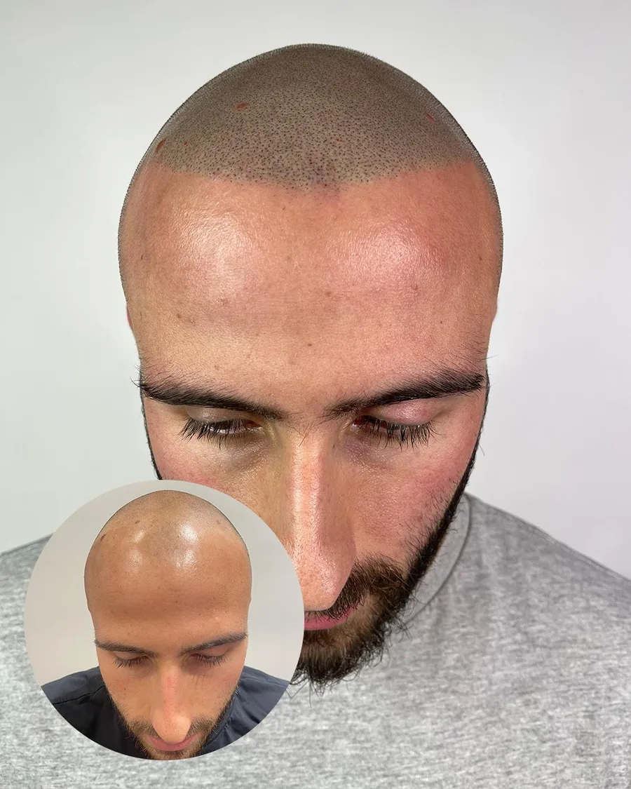 Scalp micropigmentation before and after at Erik Roberto SMP Studio