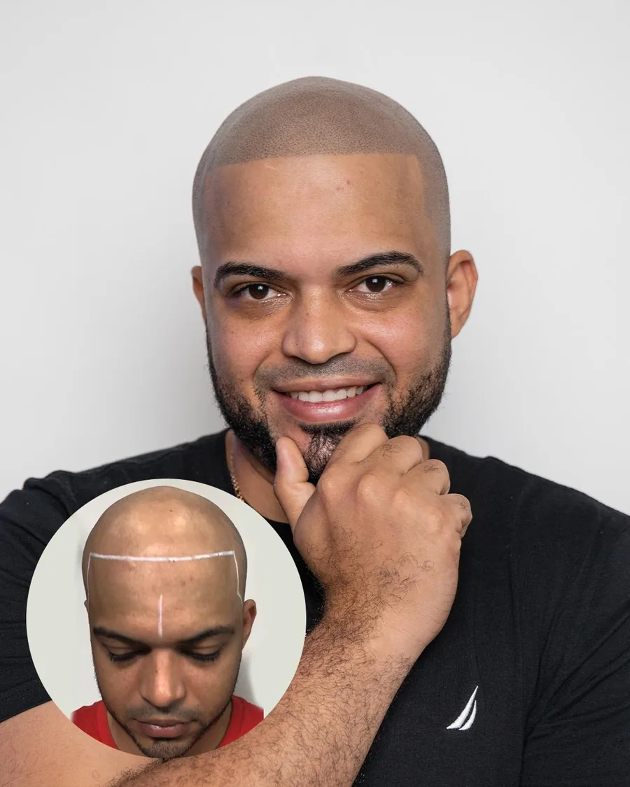 Scalp micropigmentation before and after at Erik Roberto SMP Studio