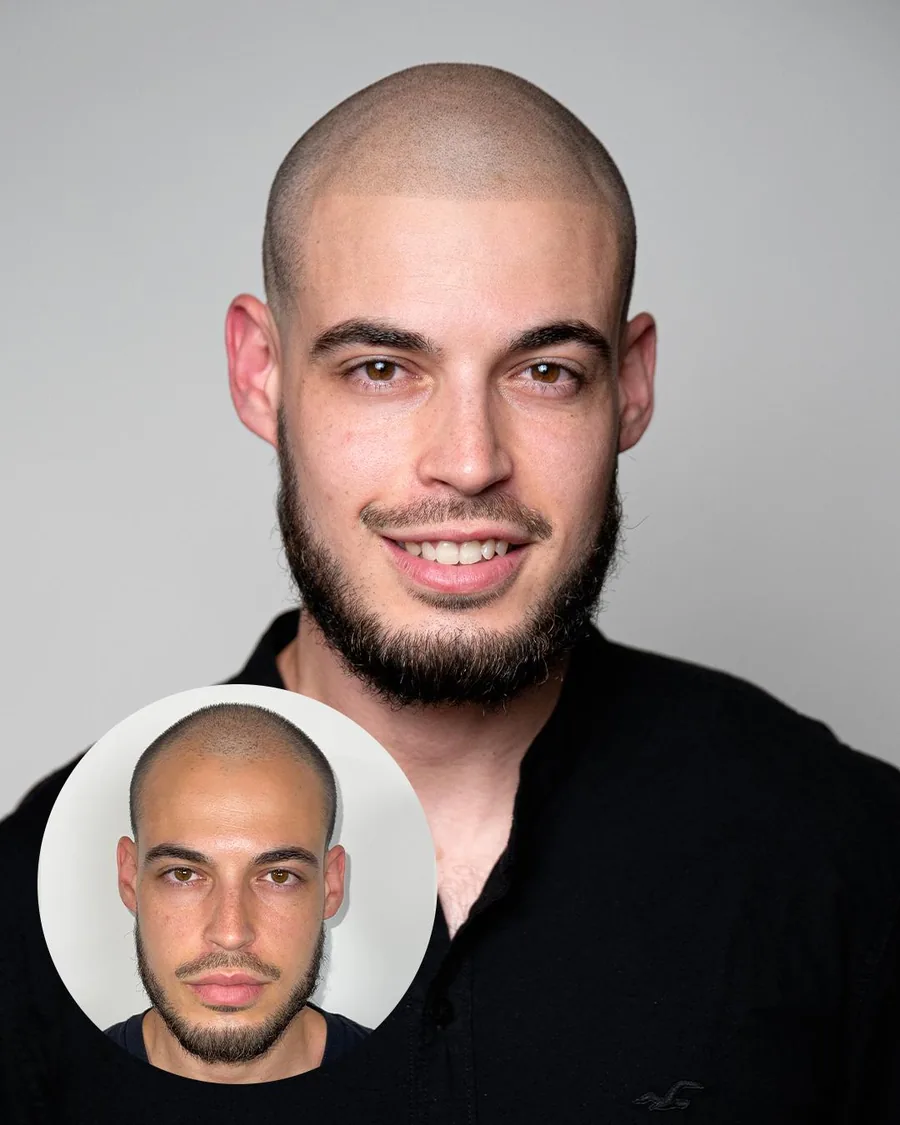 Scalp micropigmentation before and after at Erik Roberto SMP Studio