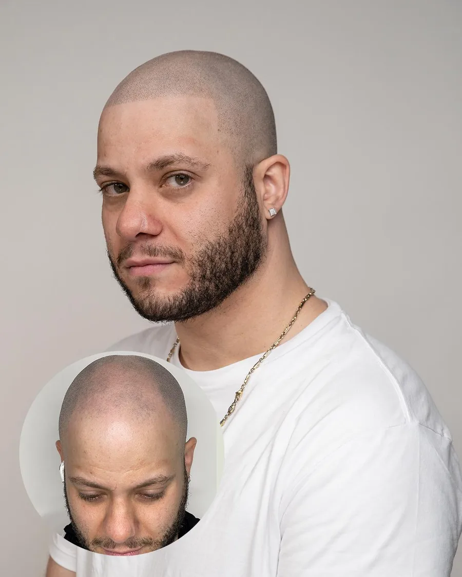 Scalp micropigmentation before and after at Erik Roberto SMP Studio