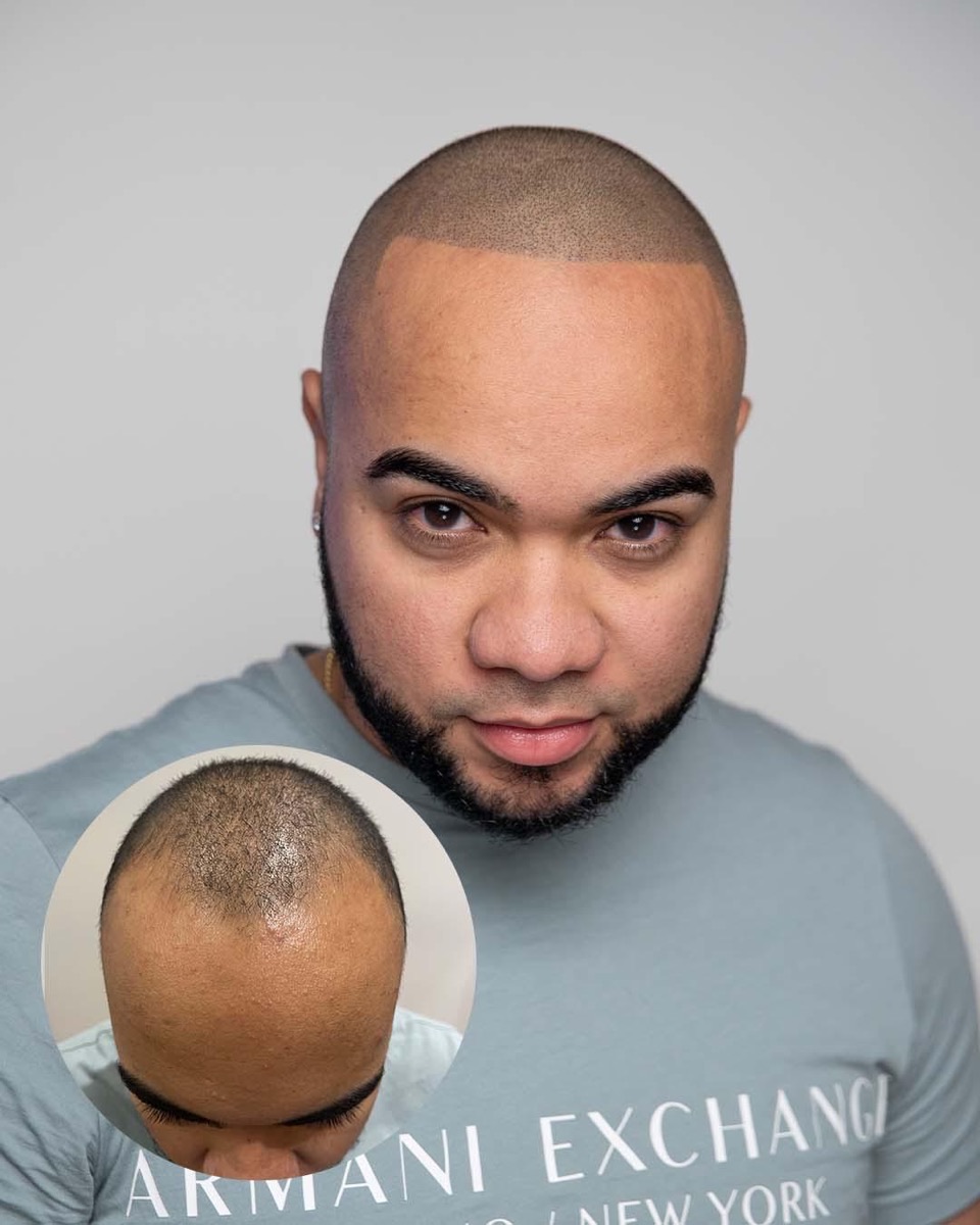 Scalp micropigmentation before and after at Erik Roberto SMP Studio