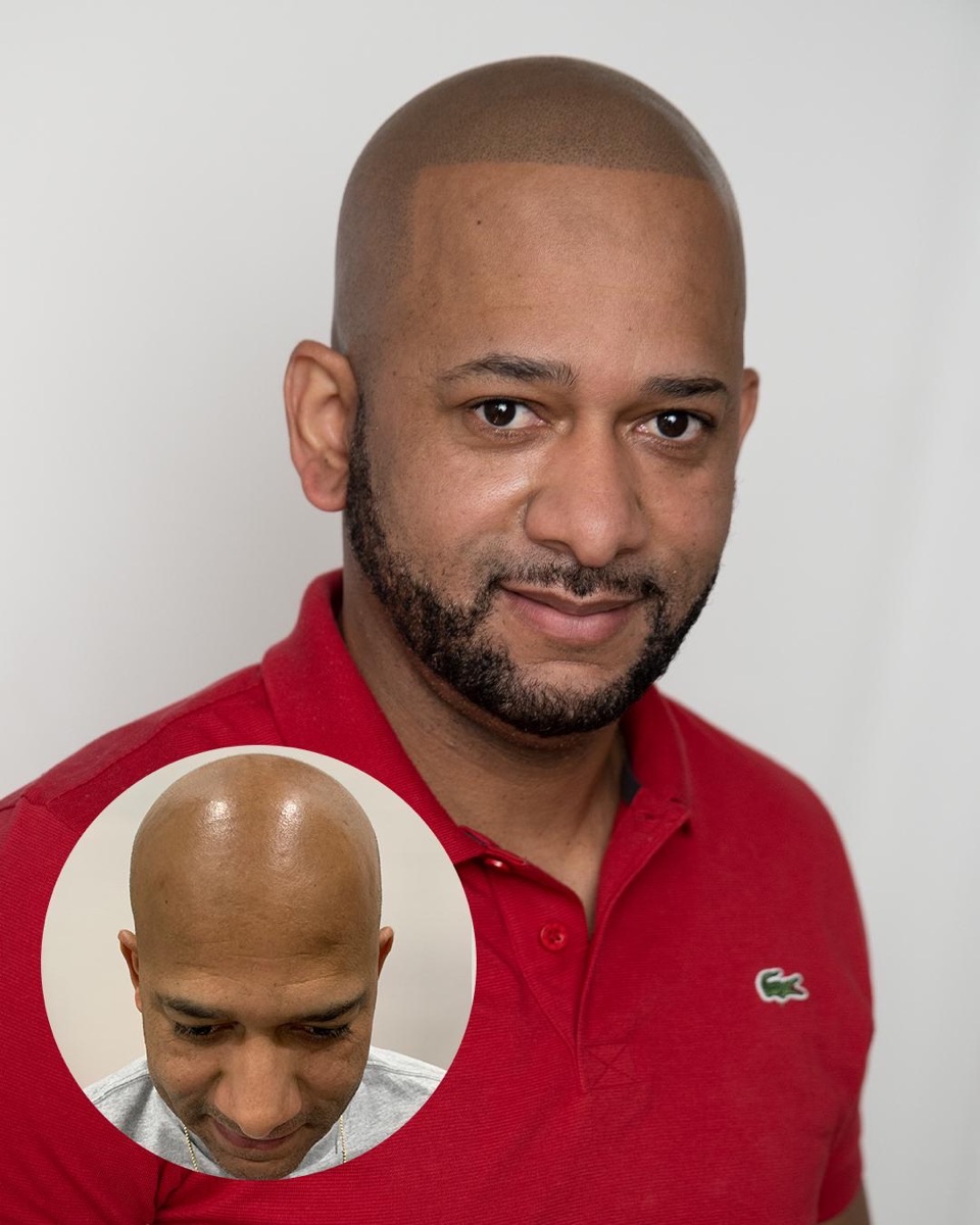 Scalp micropigmentation before and after at Erik Roberto SMP Studio