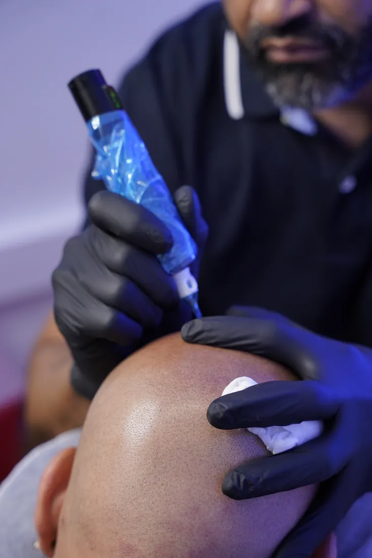 Close-up of scalp micropigmentation being applied by hand